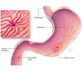 stomach ulcer