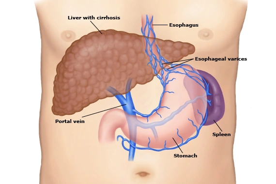 What Are Esophageal Varices