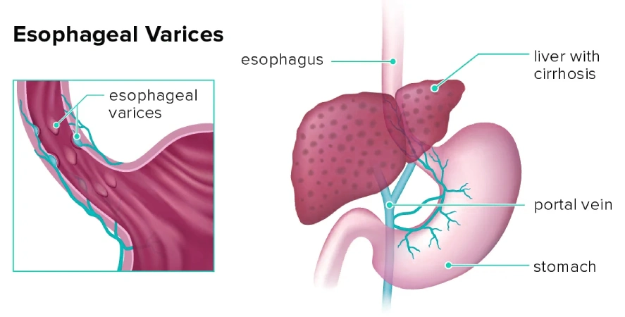 Esophageal Varices